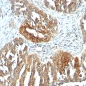 FFPE human ovarian carcinoma sections stained with 100 ul anti-VEGF (clone VEGF/1063) at 1:50. HIER epitope retrieval prior to staining was performed in 10mM Tris 1mM EDTA, pH 9.0.